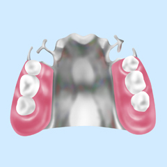 部分金属義歯