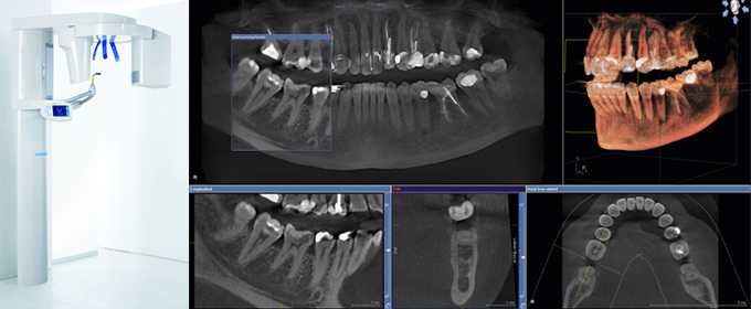 歯科用CTでインプラント治療の安全性UP