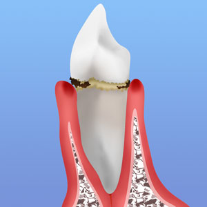 初期の歯周病