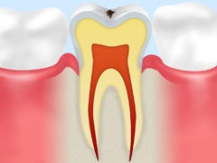 C0～初期段階の虫歯～