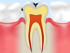 C1～エナメル質の虫歯～