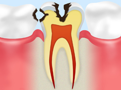 C2～象牙質の虫歯～