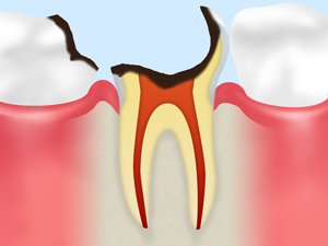 C4～歯根に達した虫歯～