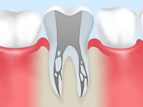 抜歯せずに大切な歯を残す「根管治療」